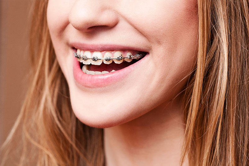 Dental Braces